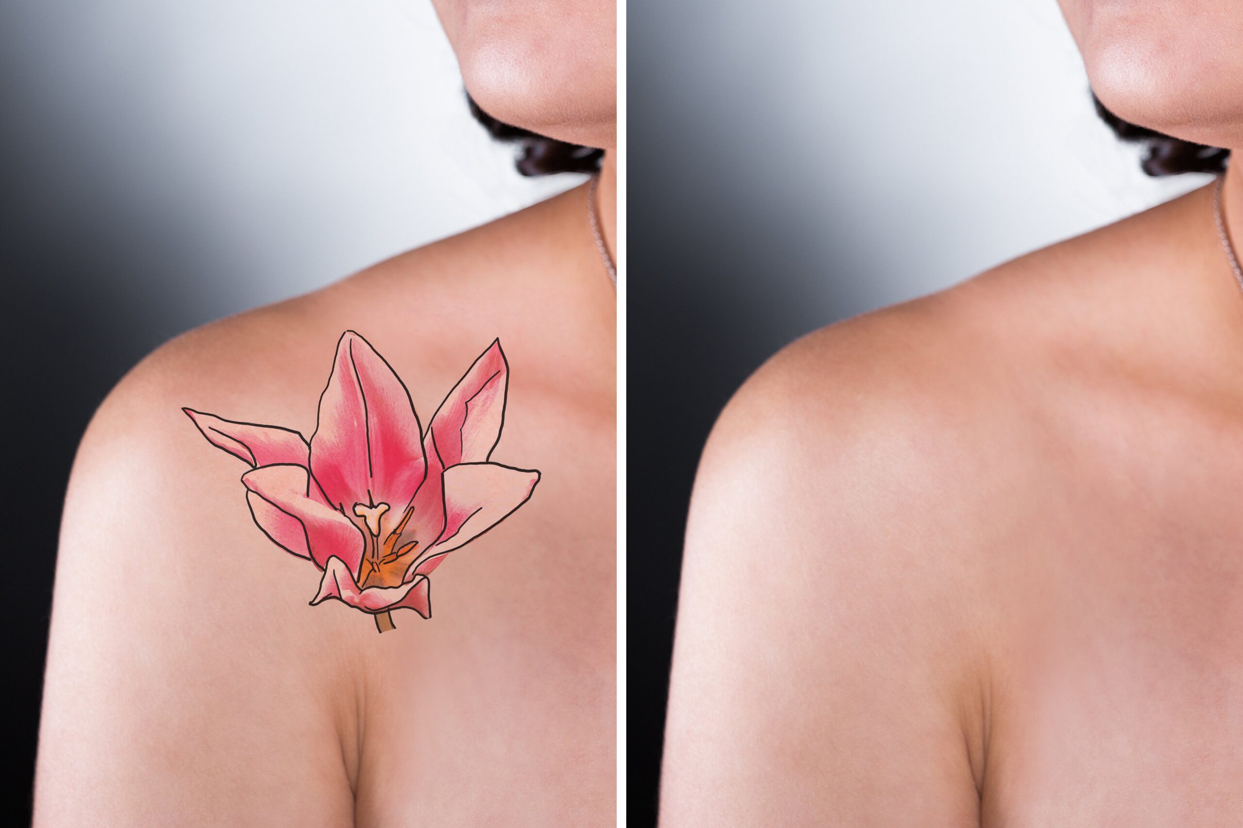 tattoo removal
