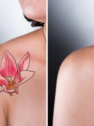 tattoo removal
